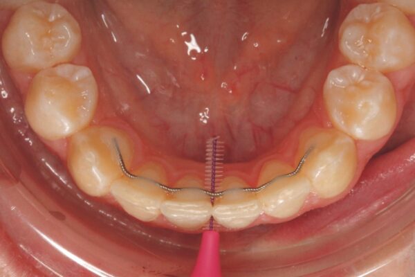 čišćenje zuba povezanih fiksnim retainerom interdentalnom četkicom